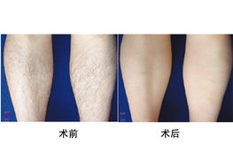 深圳美容 怎样可以脱腿毛