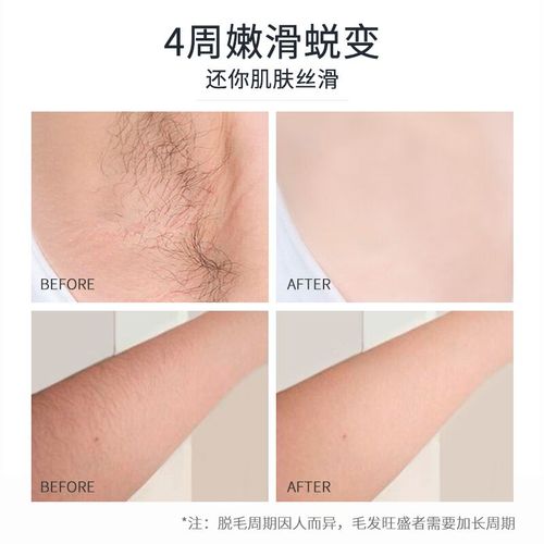 宝斯奇激光冰点脱毛仪效果好不好