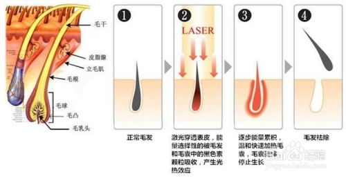 无痛脱毛仪器 专业脱毛仪器